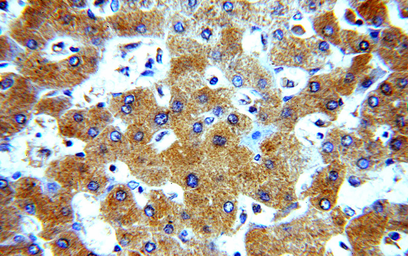 Immunohistochemical of paraffin-embedded human hepatocirrhosis using Catalog No:107664(A1BG antibody) at dilution of 1:50 (under 40x lens)
