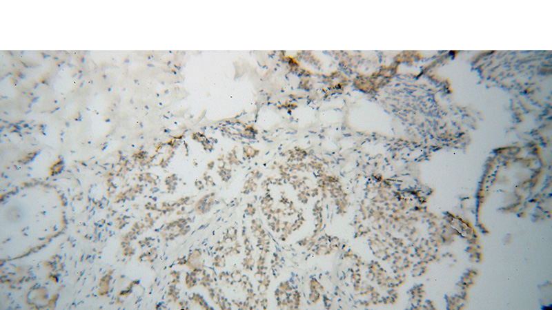 Immunohistochemical of paraffin-embedded human ovary tumor using Catalog No:114795(RPAIN antibody) at dilution of 1:50 (under 10x lens)