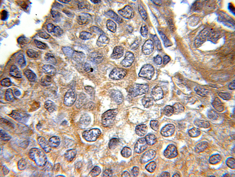 Immunohistochemical of paraffin-embedded human lung cancer using Catalog No:111590(ICAM2 antibody) at dilution of 1:50 (under 10x lens)
