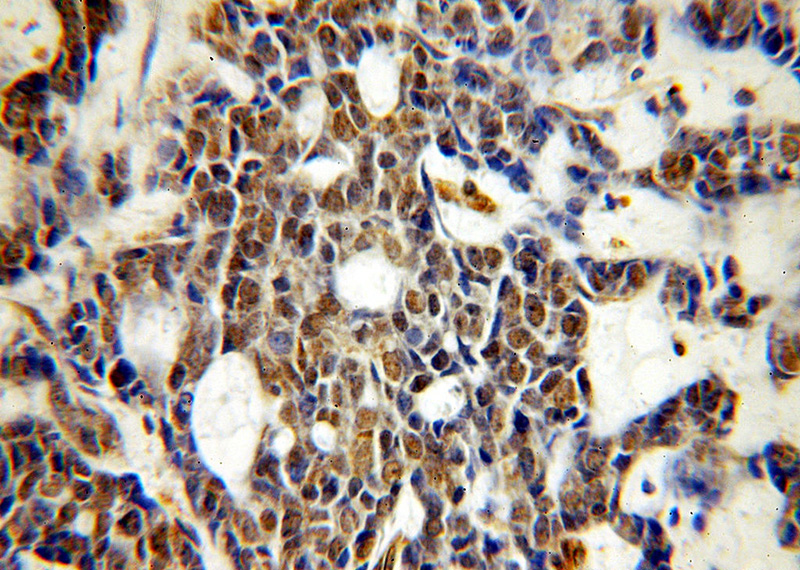 Immunohistochemical of paraffin-embedded human cervical cancer using Catalog No:116654(UBN1-Specific antibody) at dilution of 1:50 (under 40x lens)