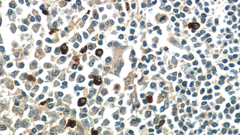 Immunohistochemistry of paraffin-embedded human tonsillitis tissue slide using Catalog No:112666(MKL1 Antibody) at dilution of 1:50 (under 40x lens)