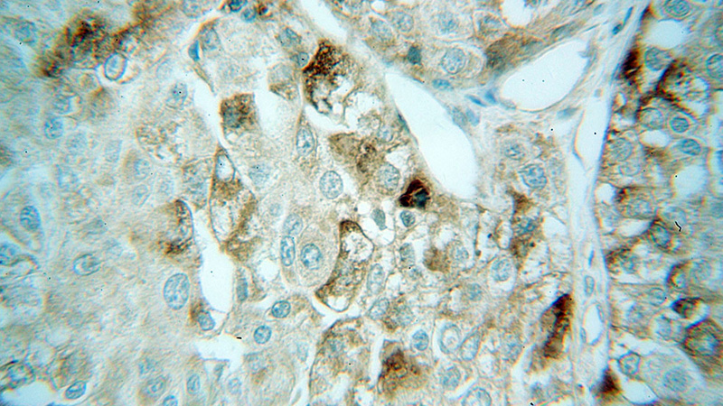 Immunohistochemical of paraffin-embedded human liver cancer using Catalog No:117072(AUP1 antibody) at dilution of 1:100 (under 40x lens)