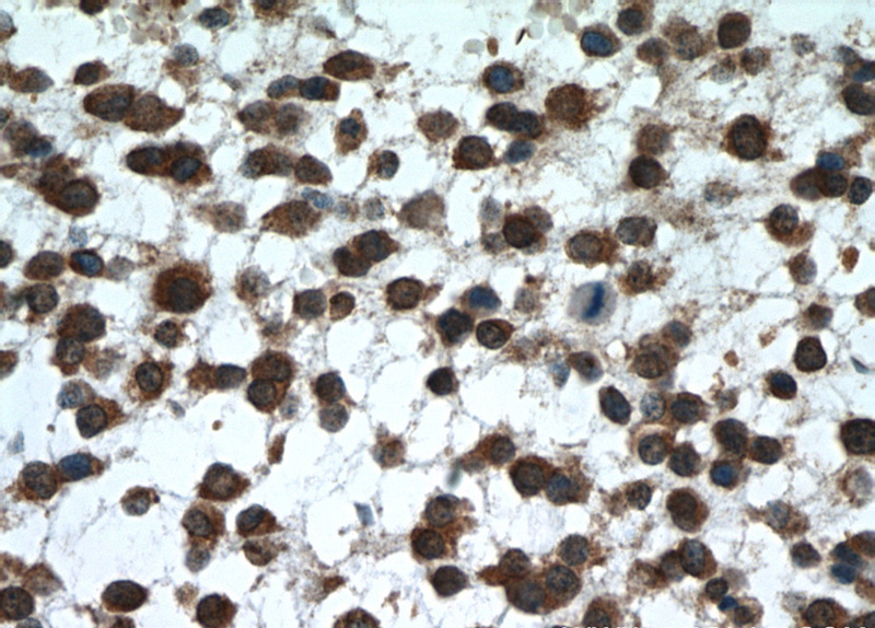 Immunohistochemical of paraffin-embedded human gliomas using Catalog No:112700(MMP2 antibody) at dilution of 1:50 (under 40x lens)