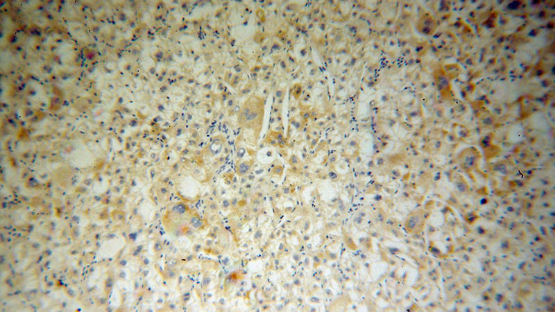 Immunohistochemical of paraffin-embedded human liver cancer using Catalog No:112629(MIPOL1 antibody) at dilution of 1:100 (under 10x lens)