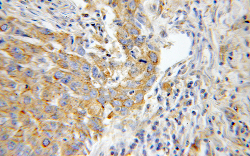 Immunohistochemical of paraffin-embedded human lung cancer using Catalog No:112937(MYH9 antibody) at dilution of 1:100 (under 40x lens)