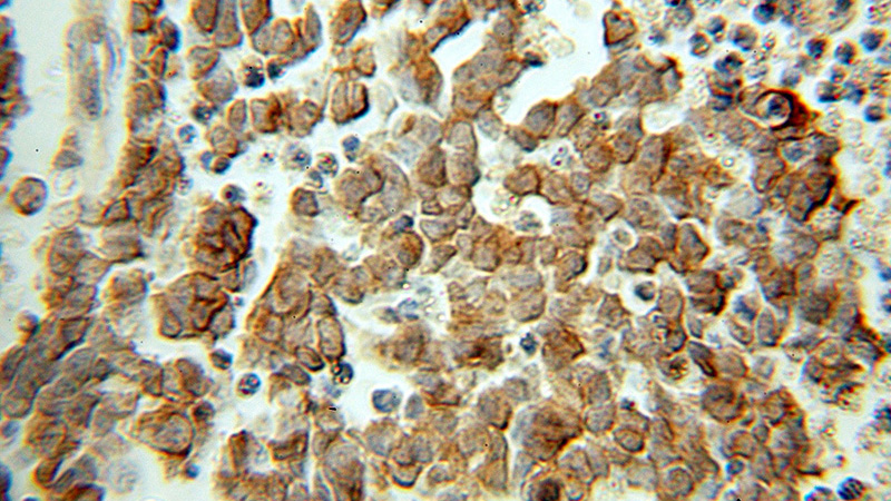Immunohistochemical of paraffin-embedded human retinoblastoma using Catalog No:108173(ARR3 antibody) at dilution of 1:50 (under 10x lens)