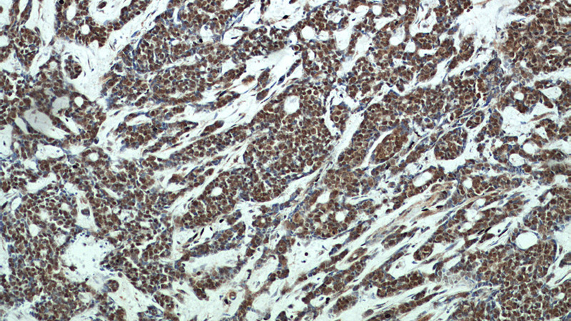 Immunohistochemical of paraffin-embedded human cervical cancer using Catalog No:116244(TOP1 antibody) at dilution of 1:50 (under 10x lens)