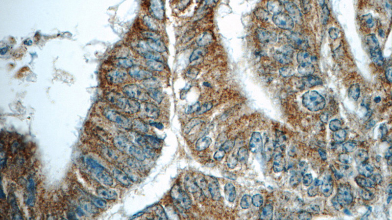Immunohistochemistry of paraffin-embedded human colon cancer tissue slide using Catalog No:108237(ARAP3 Antibody) at dilution of 1:50 (under 40x lens)