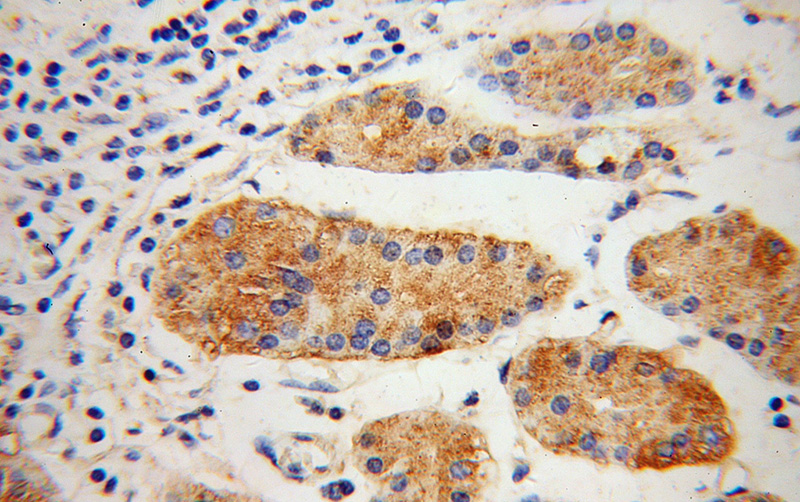 Immunohistochemical of paraffin-embedded human stomach cancer using Catalog No:107952(AAAS antibody) at dilution of 1:100 (under 40x lens)