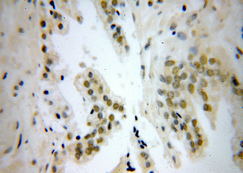 Immunohistochemical of paraffin-embedded human prostate cancer using Catalog No:113111(RDBP antibody) at dilution of 1:100 (under 40x lens)