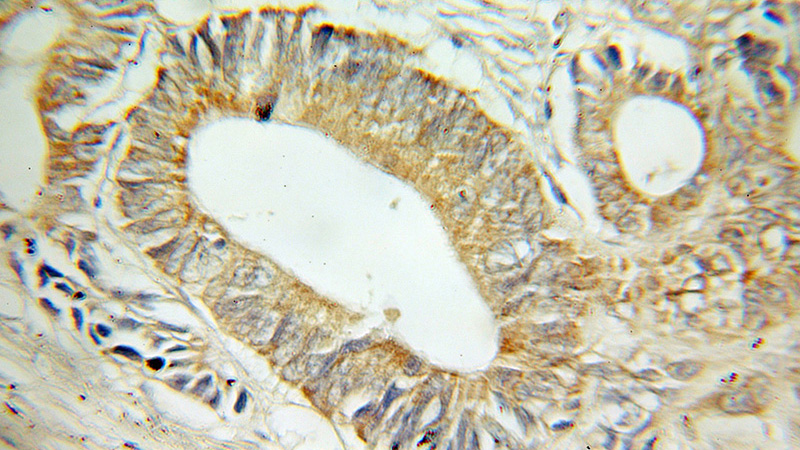 Immunohistochemical of paraffin-embedded human colon cancer using Catalog No:112878(RP6-213H19.1 antibody) at dilution of 1:100 (under 10x lens)