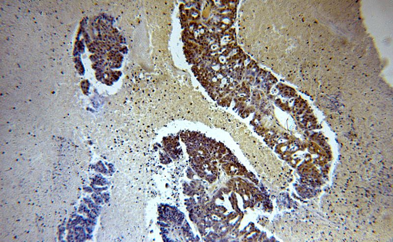 Immunohistochemical of paraffin-embedded human ovary tumor using Catalog No:115571(SPIN1 antibody) at dilution of 1:100 (under 10x lens)