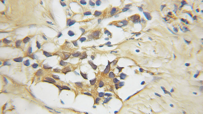 Immunohistochemical of paraffin-embedded human prostate cancer using Catalog No:112738(MOV10 antibody) at dilution of 1:50 (under 25x lens)