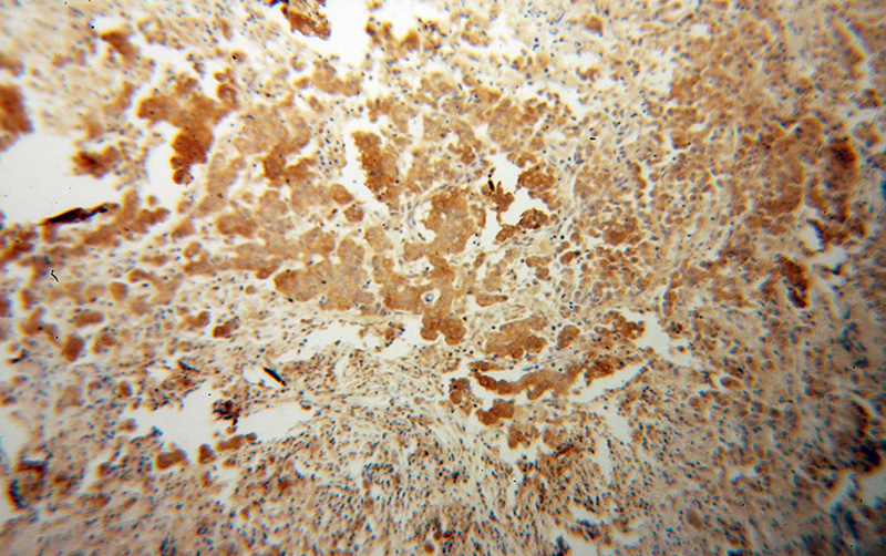 Immunohistochemical of paraffin-embedded human prostate cancer using Catalog No:116435(TSLP antibody) at dilution of 1:50 (under 10x lens)