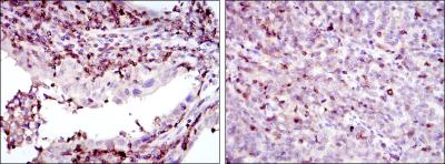 Immunohistochemical analysis of paraffin-embedded endometrial cancer tissues (left) and cervical cancer tissues (right) using GRK2 mouse mAb with DAB staining.