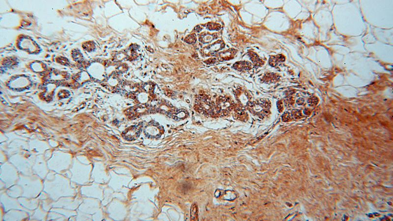 Immunohistochemical of paraffin-embedded human colon cancer using Catalog No:112812(MRPL13 antibody) at dilution of 1:50 (under 10x lens)