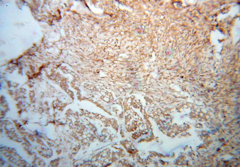 Immunohistochemical of paraffin-embedded human ovary tumor using Catalog No:114366(QDPR antibody) at dilution of 1:100 (under 10x lens)