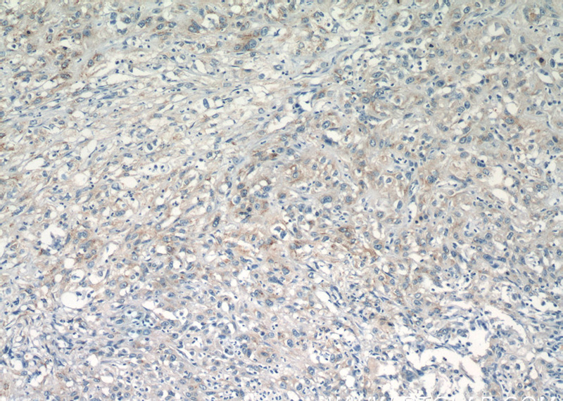 Immunohistochemistry of paraffin-embedded human cervical cancer tissue slide using Catalog No:115756(SYAP1 Antibody) at dilution of 1:50 (under 10x lens)