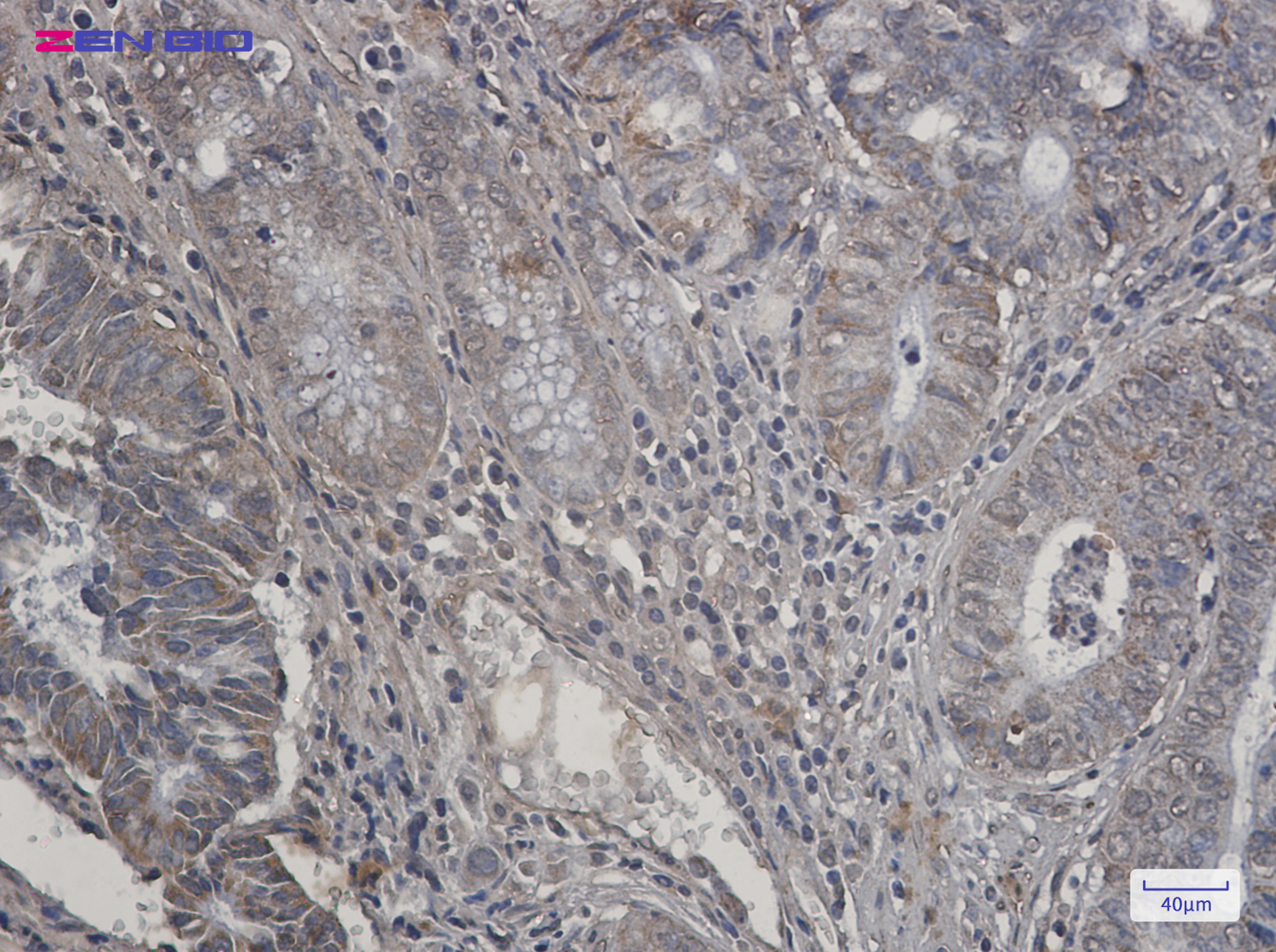 Immunohistochemistry of P70 S6 Kinase beta in paraffin-embedded Human colon cancer tissue using P70 S6 Kinase beta Rabbit pAb at dilution 1/20