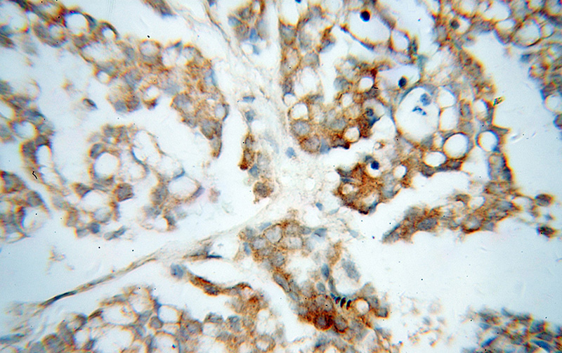 Immunohistochemical of paraffin-embedded human ovary tumor using Catalog No:114366(QDPR antibody) at dilution of 1:100 (under 40x lens)