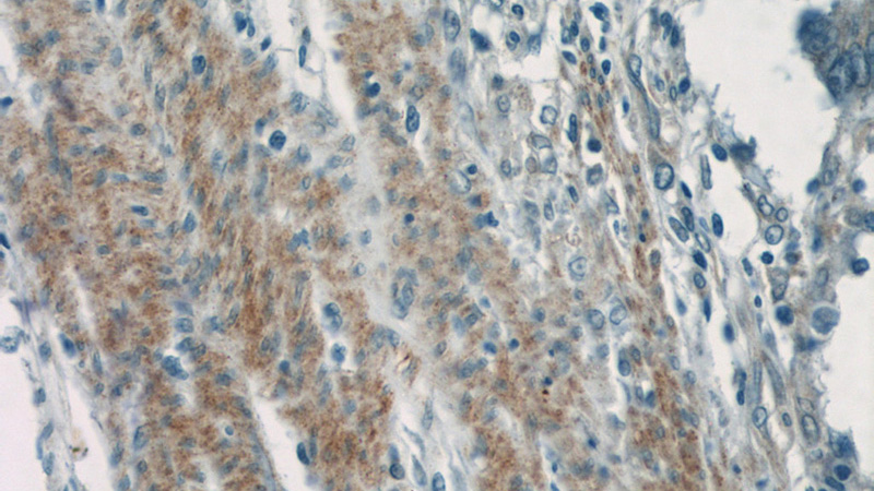 Immunohistochemistry of paraffin-embedded human colon cancer tissue slide using Catalog No:108012(AMTN Antibody) at dilution of 1:50 (under 40x lens)