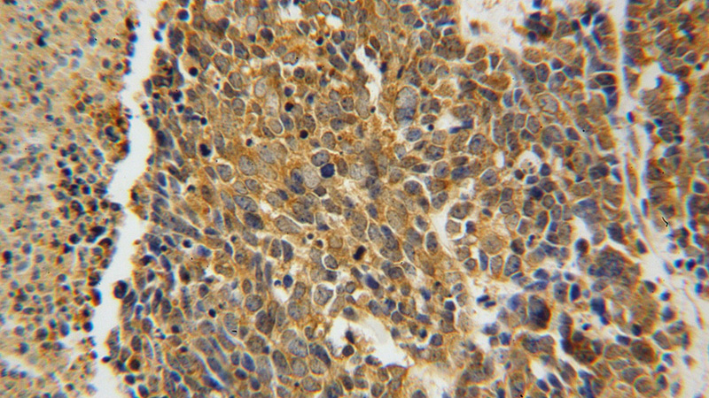Immunohistochemical of paraffin-embedded human lung cancer using Catalog No:108863(CARS antibody) at dilution of 1:100 (under 40x lens)