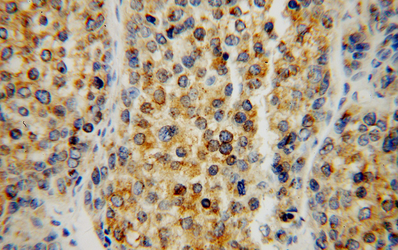 Immunohistochemical of paraffin-embedded human liver cancer using Catalog No:115228(SIGMAR1 antibody) at dilution of 1:50 (under 40x lens)