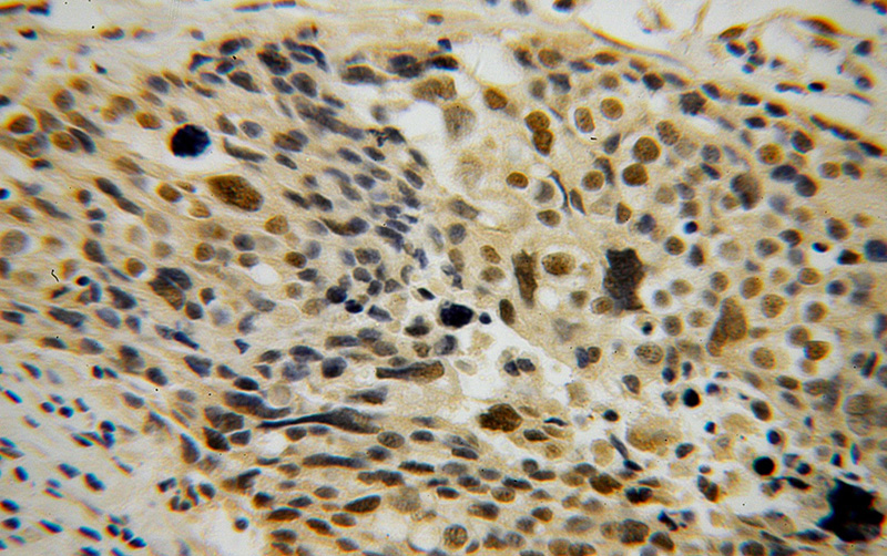 Immunohistochemical of paraffin-embedded human ovary tumor using Catalog No:108857(CARD8 antibody) at dilution of 1:50 (under 40x lens)