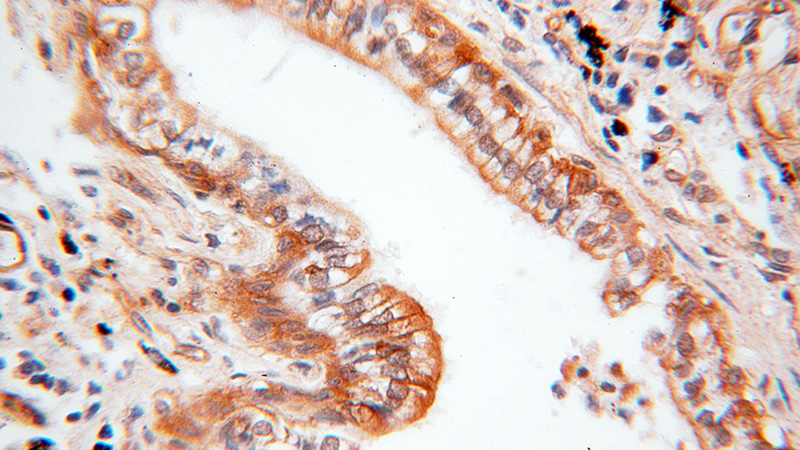Immunohistochemical of paraffin-embedded human lung cancer using Catalog No:109069(CCNI2 antibody) at dilution of 1:100 (under 40x lens)