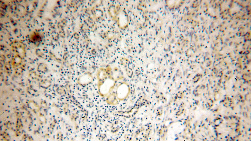 Immunohistochemical of paraffin-embedded human pancreas cancer using Catalog No:109894(DPT antibody) at dilution of 1:100 (under 10x lens)