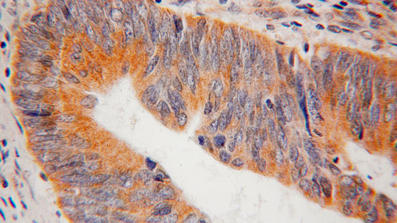 Immunohistochemical of paraffin-embedded human colon cancer using Catalog No:115066(SAR1B antibody) at dilution of 1:100 (under 40x lens)