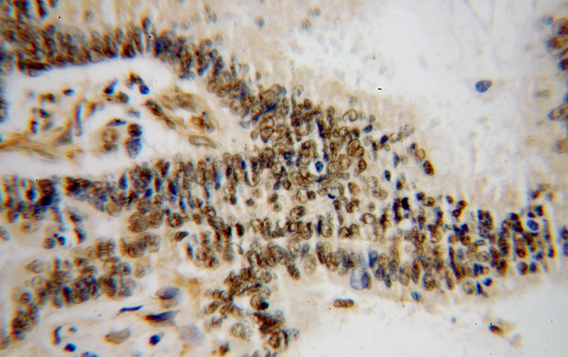 Immunohistochemical of paraffin-embedded human colon cancer using Catalog No:111506(HNRNPF antibody) at dilution of 1:50 (under 40x lens)