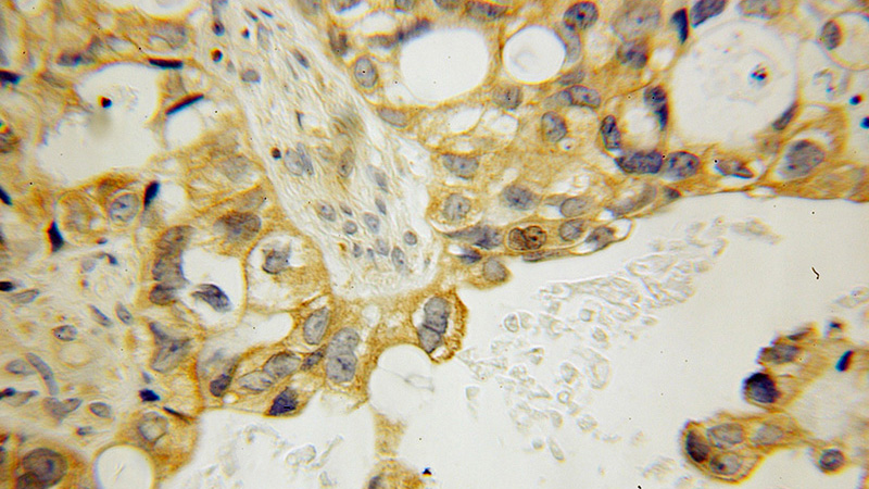 Immunohistochemical of paraffin-embedded human ovary tumor using Catalog No:112751(MPP7 antibody) at dilution of 1:100 (under 10x lens)