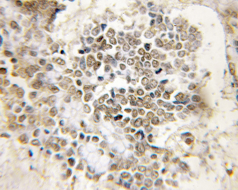 Immunohistochemical of paraffin-embedded human colon cancer using Catalog No:113713(PER3 antibody) at dilution of 1:50 (under 10x lens)