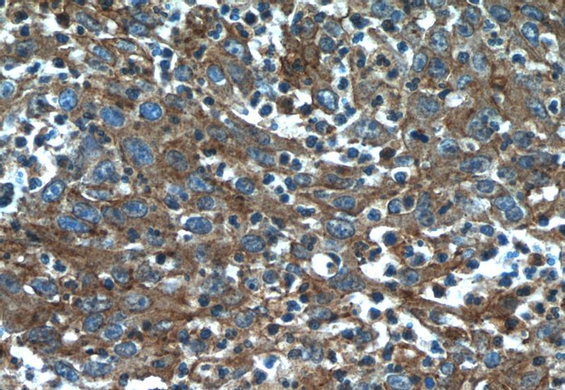Immunohistochemistry of paraffin-embedded human colon cancer tissue slide using Catalog No:109685(CYP1B1 Antibody) at dilution of 1:50 (under 40x lens)