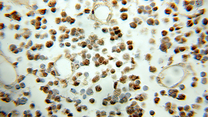 Immunohistochemical of paraffin-embedded human gliomas using Catalog No:115466(SNRPN antibody) at dilution of 1:100 (under 10x lens)