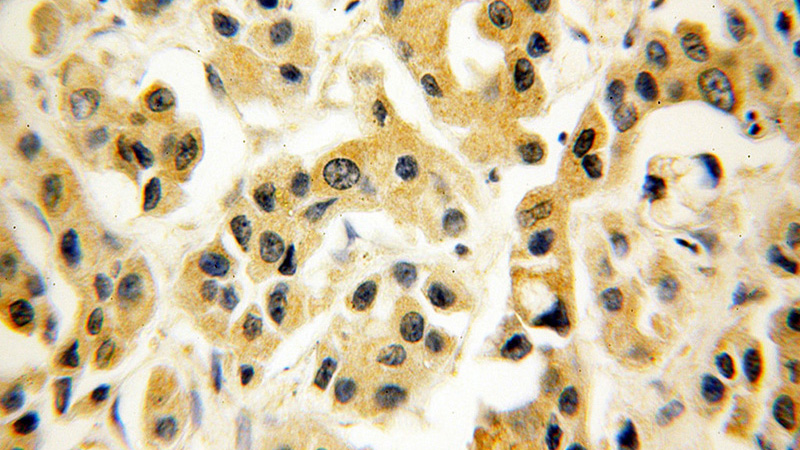 Immunohistochemical of paraffin-embedded human breast cancer using Catalog No:108866(CSNK1E antibody) at dilution of 1:50 (under 40x lens)