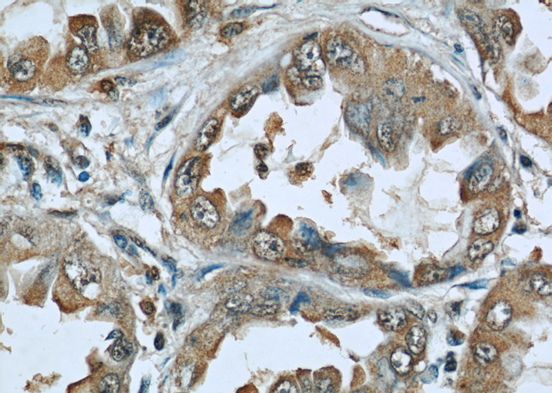 Immunohistochemical of paraffin-embedded human lung cancer using Catalog No:107035(CAV1 antibody) at dilution of 1:50 (under 40x lens)
