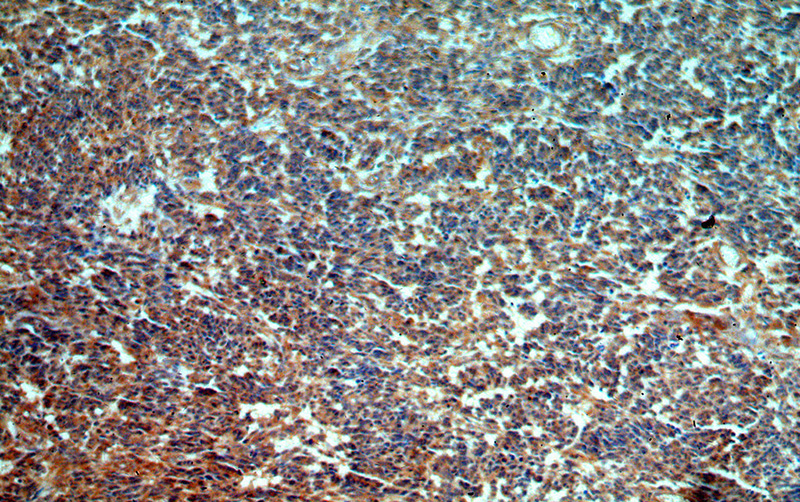 Immunohistochemical of paraffin-embedded human gliomas using Catalog No:115638(STAC3 antibody) at dilution of 1:50 (under 10x lens)
