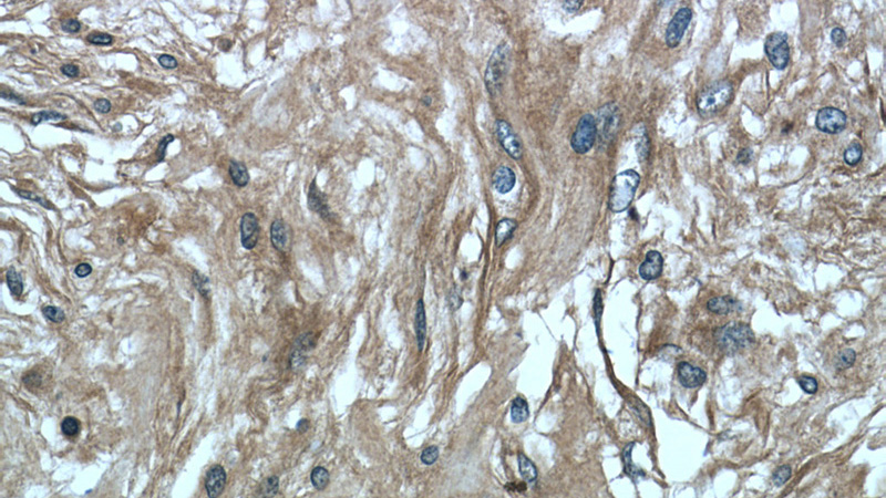 Immunohistochemistry of paraffin-embedded human meningioma tissue slide using Catalog No:117110(BCRP,ABCG2 Antibody) at dilution of 1:50 (under 40x lens)