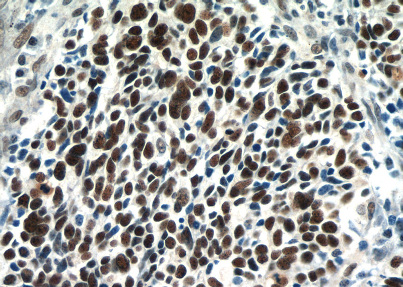 Immunohistochemical of paraffin-embedded human lung cancer using Catalog No:115427(SMARCA4 antibody) at dilution of 1:100 (under 40x lens)