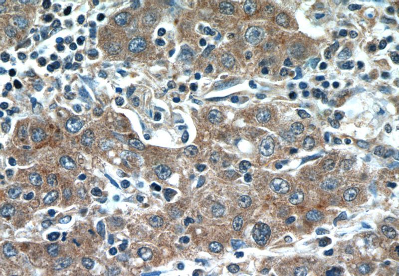 Immunohistochemistry of paraffin-embedded human liver cancer tissue slide using Catalog No:111088(GPC3 Antibody) at dilution of 1:50 (under 40x lens)