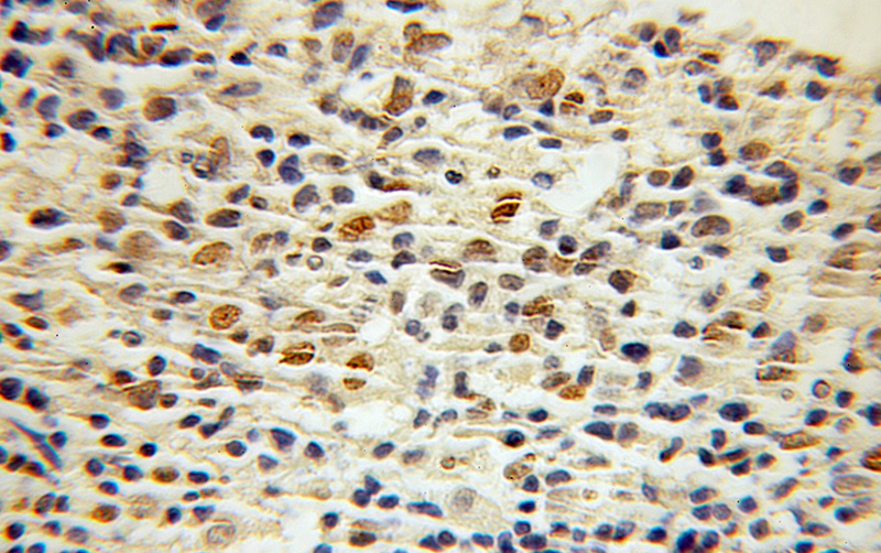 Immunohistochemical of paraffin-embedded human lymphoma using Catalog No:109719(CTCF antibody) at dilution of 1:100 (under 10x lens)