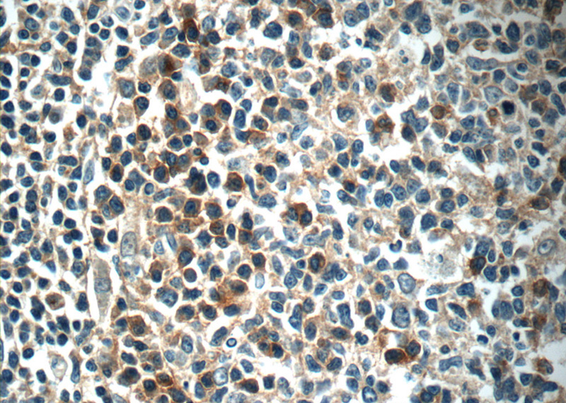 Immunohistochemistry of paraffin-embedded human tonsillitis tissue slide using Catalog No:110494(EVI2B Antibody) at dilution of 1:50 (under 40x lens)