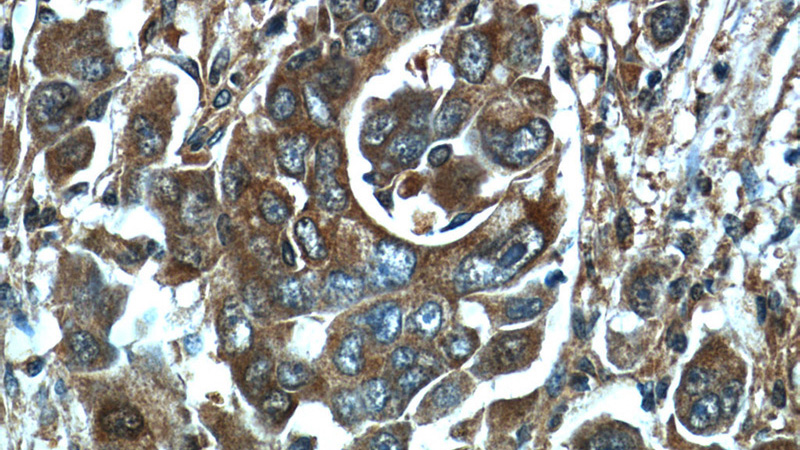 Immunohistochemistry of paraffin-embedded human liver cancer tissue slide using Catalog No:111484(HMGCR Antibody) at dilution of 1:50 (under 40x lens)