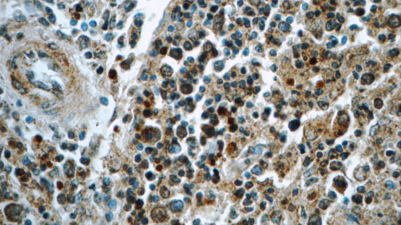 Immunohistochemistry of paraffin-embedded human spleen tissue slide using Catalog No:115761(SYK Antibody) at dilution of 1:50 (under 40x lens)