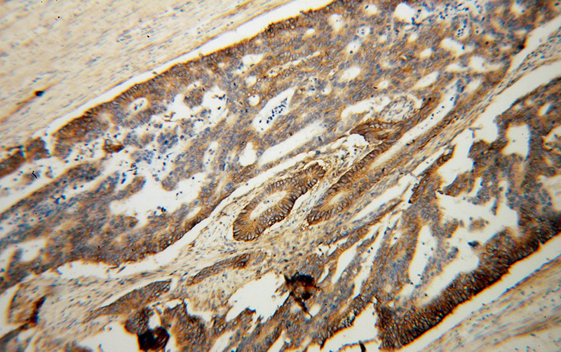 Immunohistochemical of paraffin-embedded human colon cancer using Catalog No:113194(SLC12A2 antibody) at dilution of 1:100 (under 10x lens)