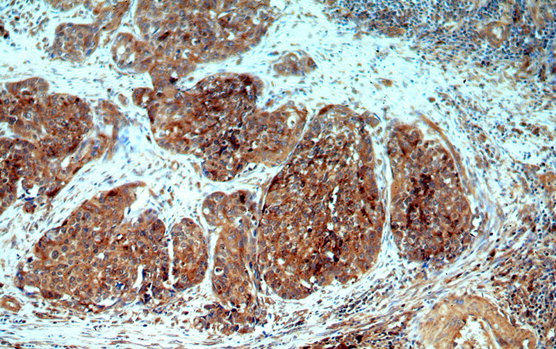 Immunohistochemical of paraffin-embedded human cervical cancer using Catalog No:108174(ARSA antibody) at dilution of 1:50 (under 10x lens)