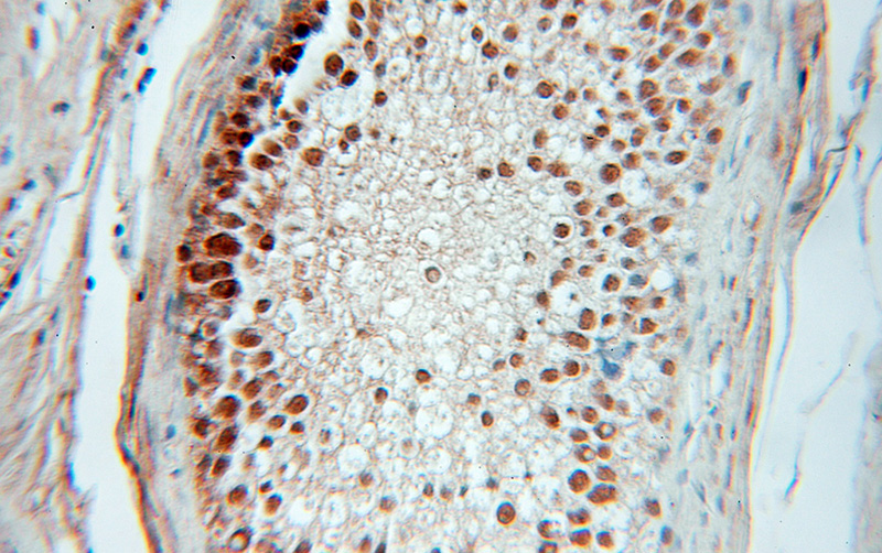 Immunohistochemical of paraffin-embedded human prostate cancer using Catalog No:109372(COIL antibody) at dilution of 1:100 (under 10x lens)