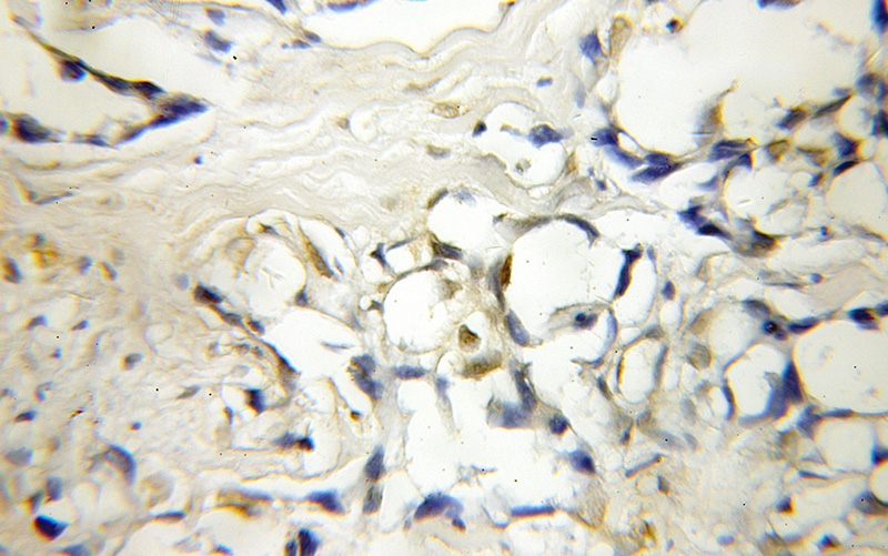 Immunohistochemical of paraffin-embedded human lung cancer using Catalog No:111815(IP6K1 antibody) at dilution of 1:50 (under 10x lens)